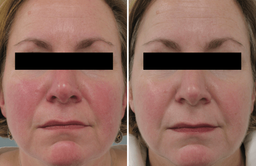 rosacea_ba_1_lg.png